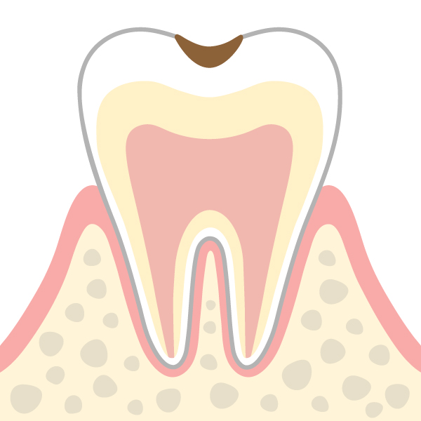 エナメル質の虫歯