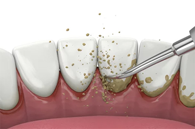 予防歯科/PMTC